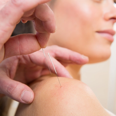 A woman receiving acupuncture on her shoulder.